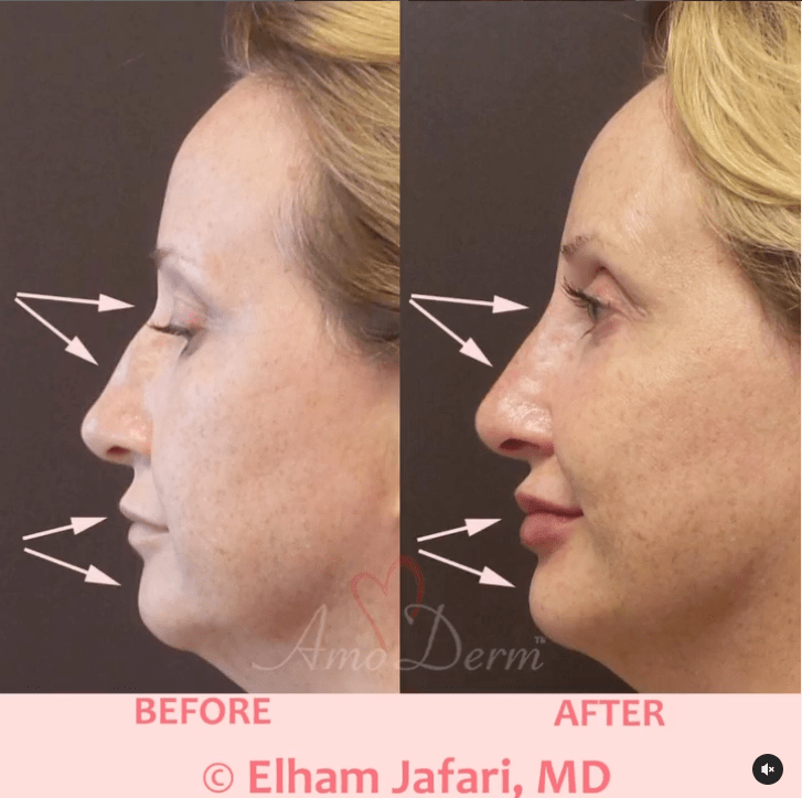 Non-surgical nose job (liquid rhinoplasty), lip augmentation and lower face scultping