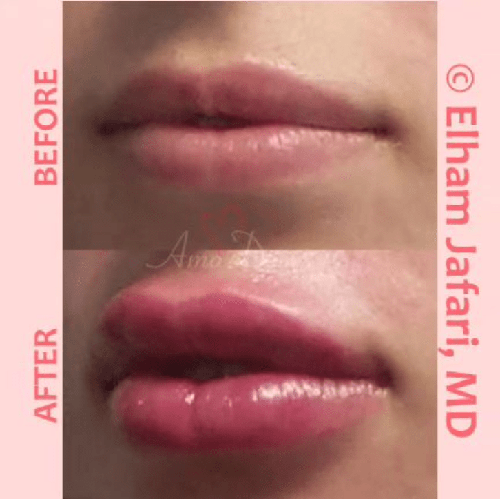 Lip augmentation and enhancement