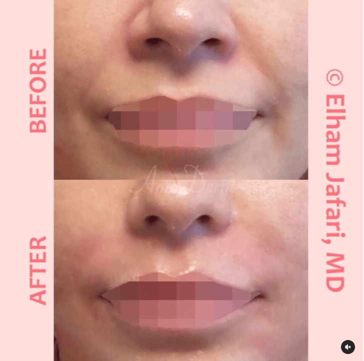 Treatment of nasolabial folds (laugh lines) and marionette lines and folds around the mouth as part of non-surgical facelift (AKA Liquid Facelift)