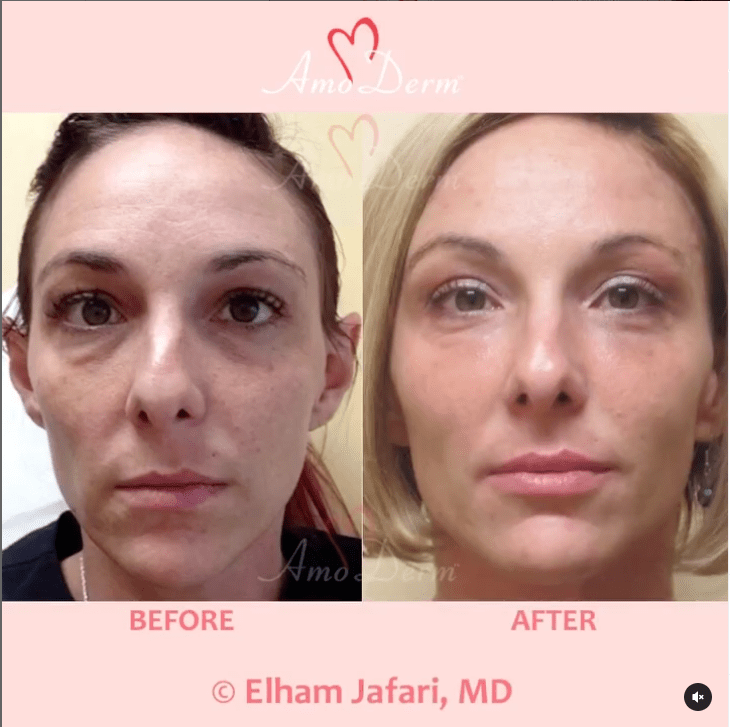 njection of dermal fillers in temples, cheeks, under the eyes (4D Under Eye Lift) and jaw lines performed by experienced MD