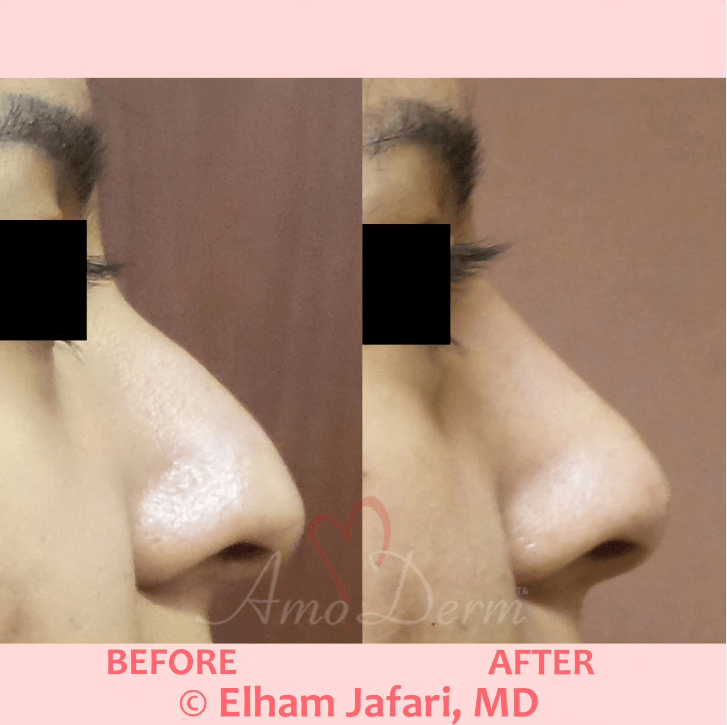 (liquid rhinoplasty) to correct nose bumps or humps and sculpting and reconstructing nose bridge with filler injection