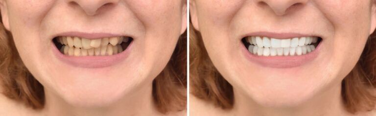 Teeth of a woman before correction and whitening