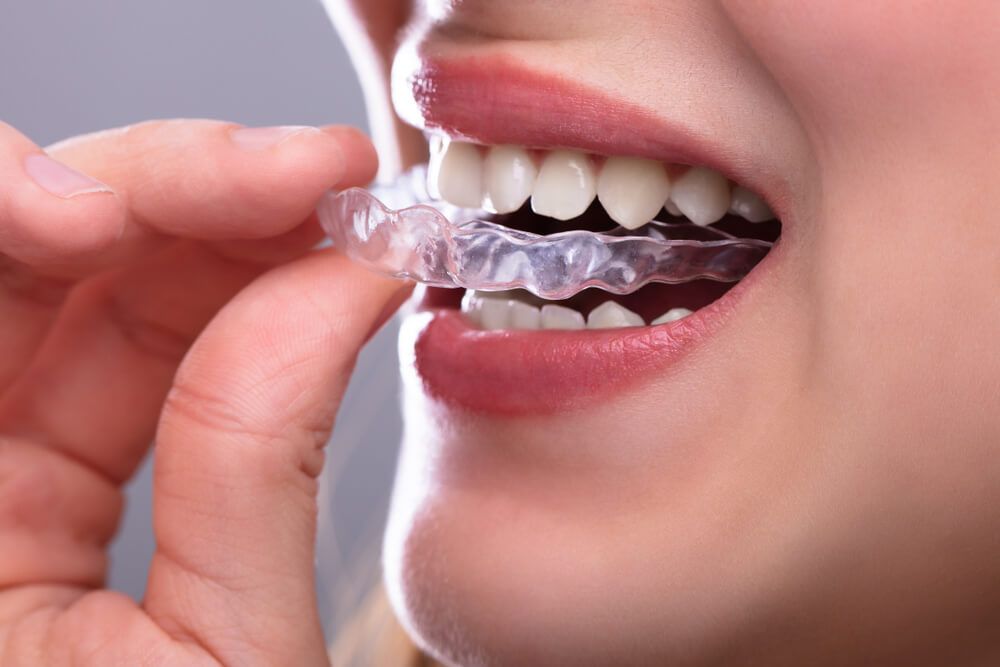 Woman's Hand Putting Transparent Aligner In Teeth