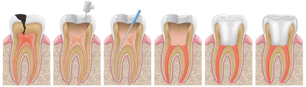 An illustration of the Root Canal treatment process