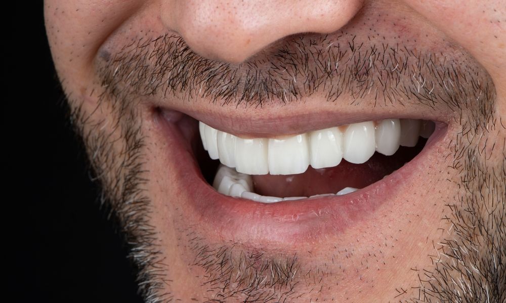 A man smiling after receiving Veneers and Laminates