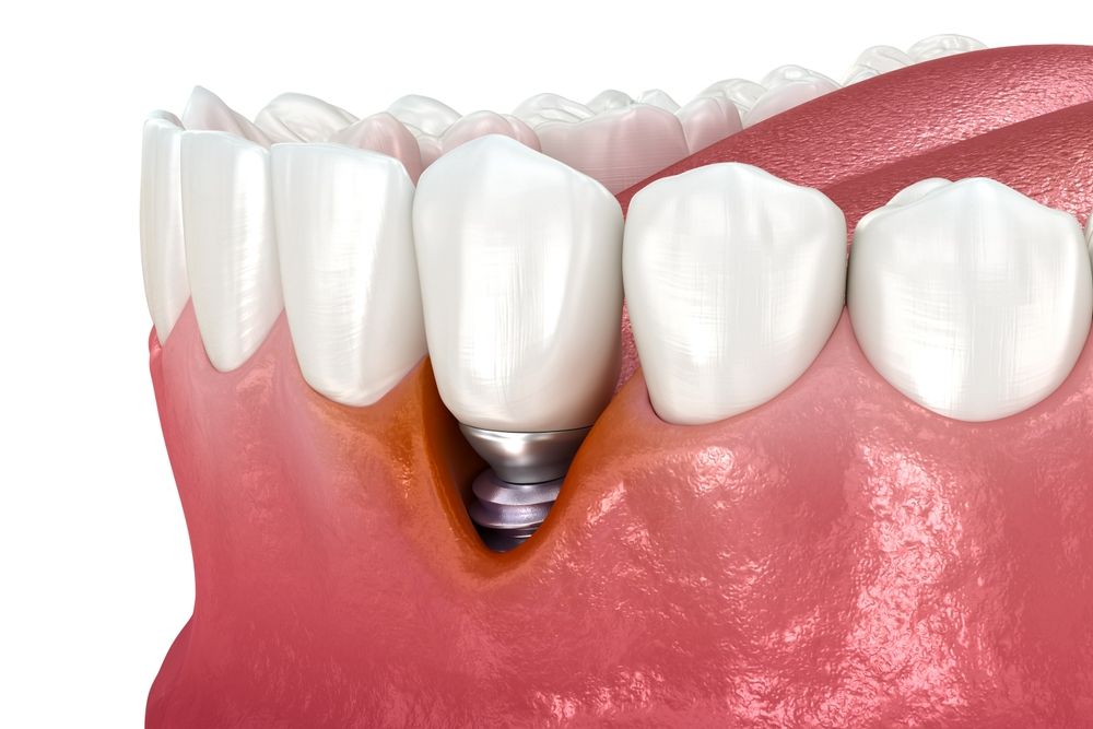 A 3d Illustration of Dental Implants