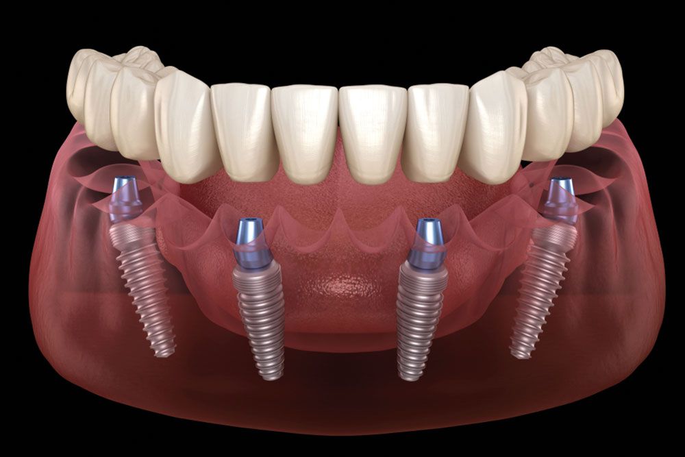 Mandibular prosthesis All on 4 system supported by implants