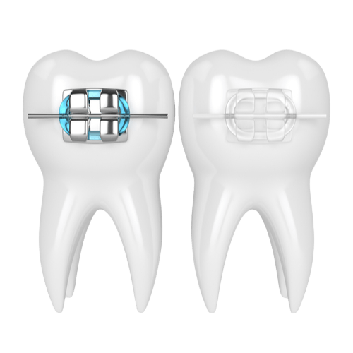 3d render of teeth with ceramic and metal braces