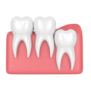 3d render of teeth with wisdom vertical impaction