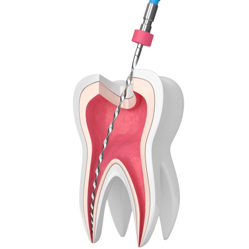 3d render of tooth with endodontic file