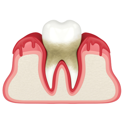 3d render of tooth in bleeding gums