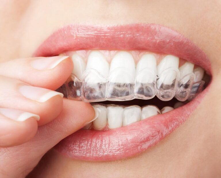 Woman using Invisalign
