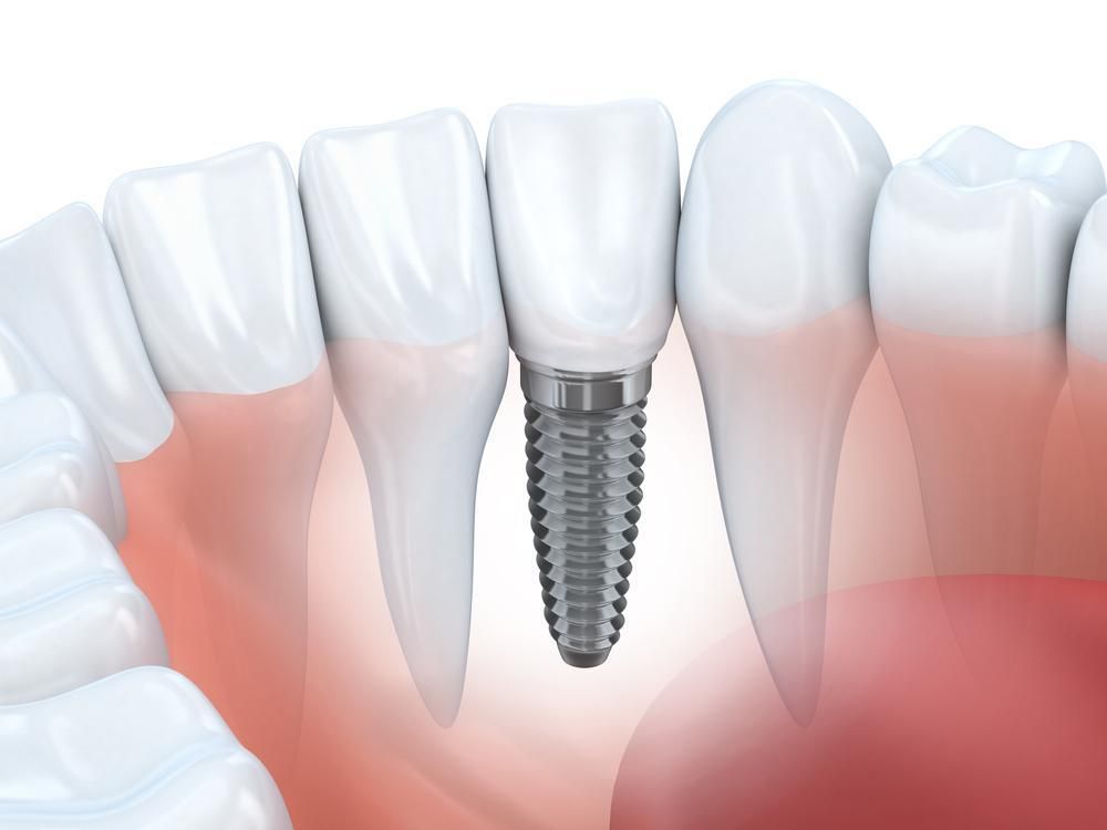 Dental implant 3D image