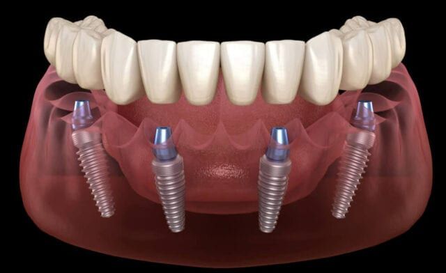all-on-4 implants