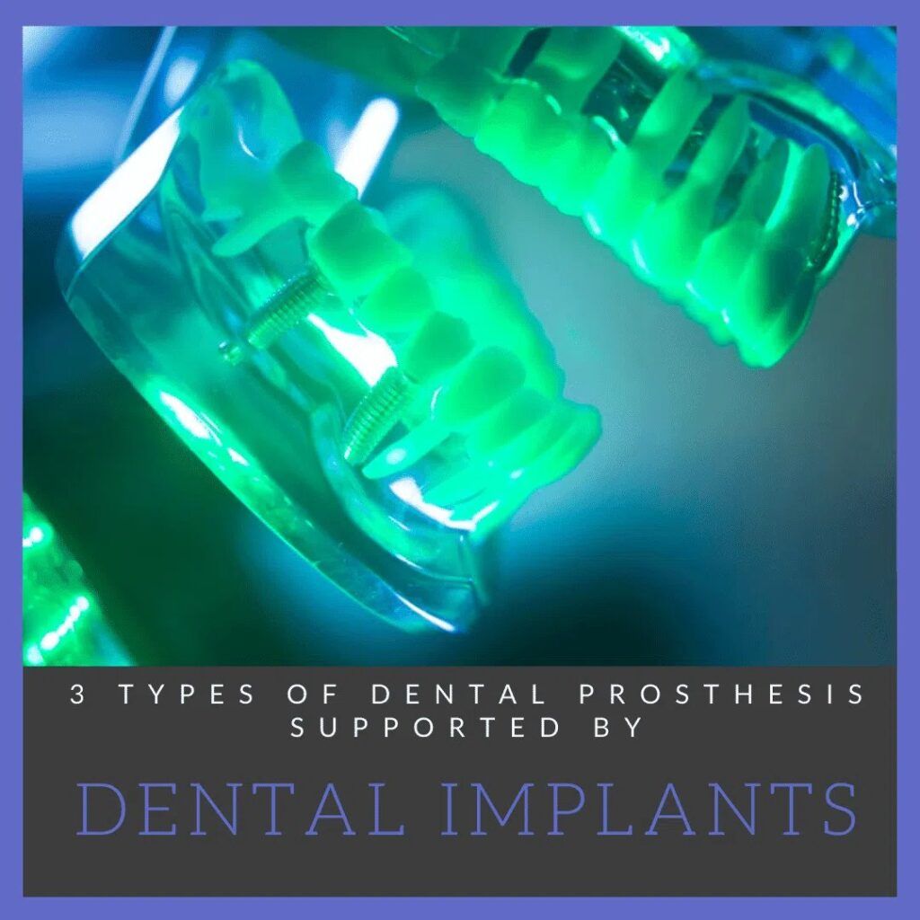 Dental Implants model