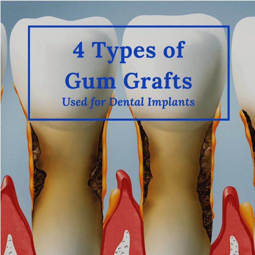 Gum Grafts Used for Dental Implants