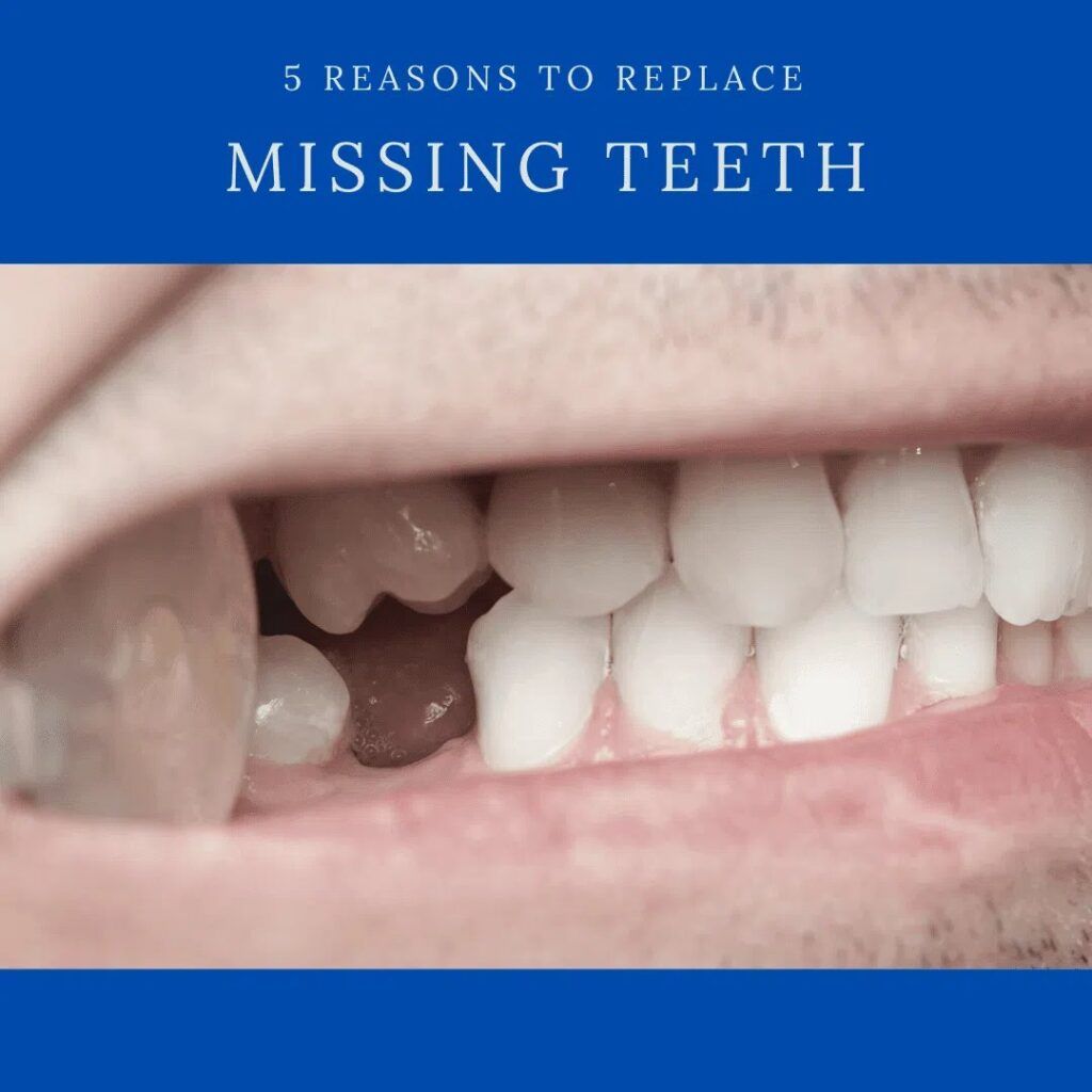 Missing teeth