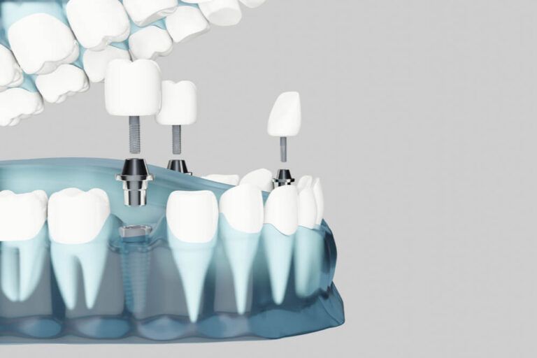 Component of Dental implants and copy space