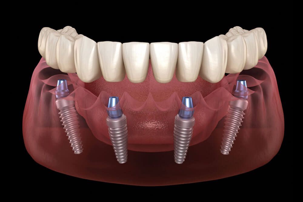 All on 4 system supported by implants