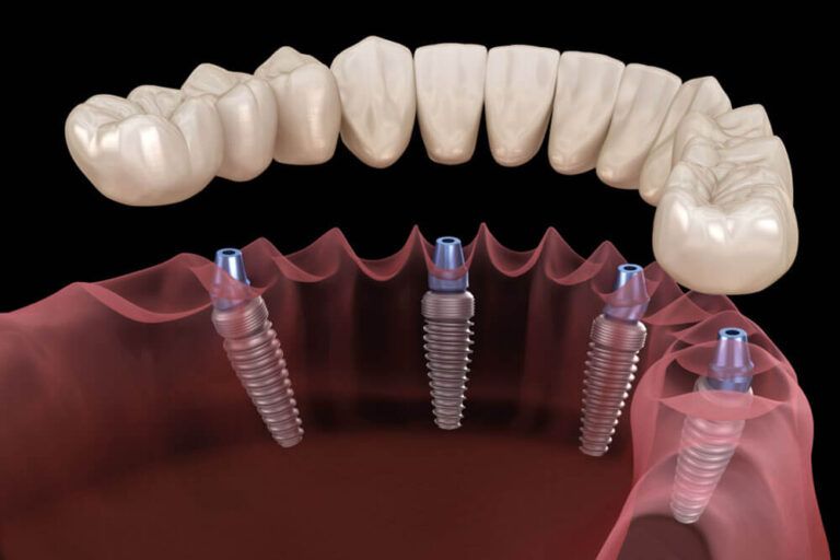 Mandibular prosthesis All on 4 system supported by implants.