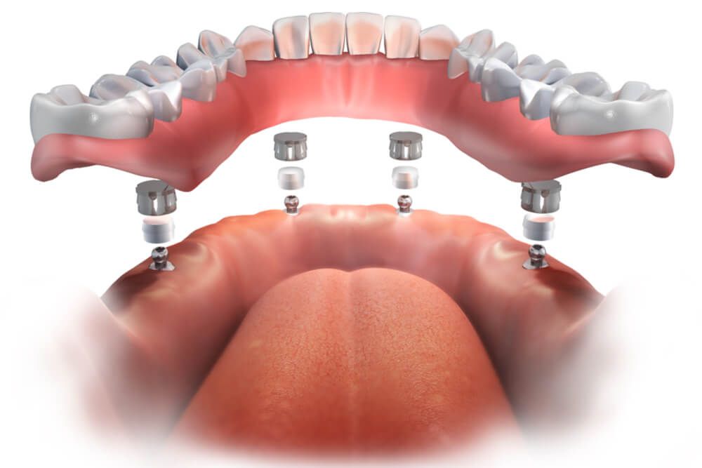 Lower Implant supported Complete Denture