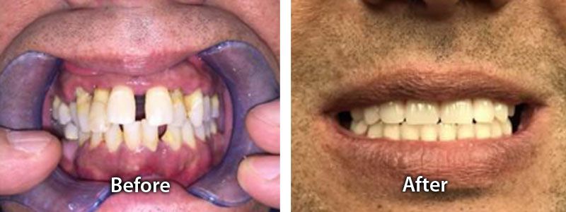 Deteriorating Gum Line and Jawbone Before after image