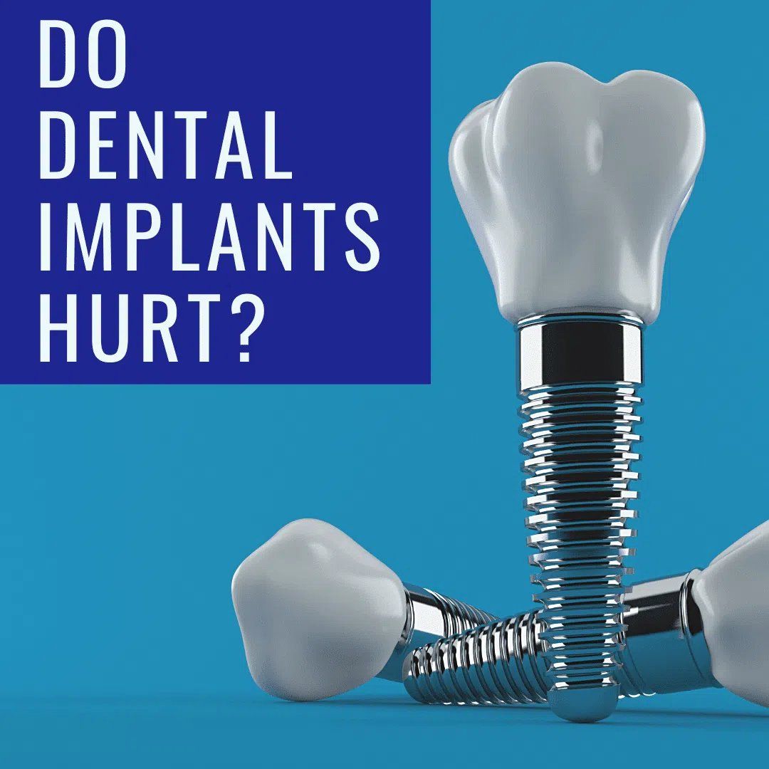 Dental Implants 3D image