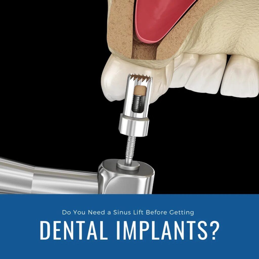 Sinus Lift treatment