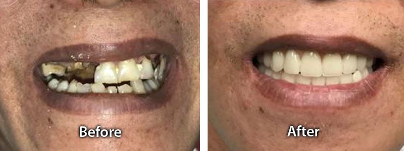 Extraction, Sedation and Implant Surgery Before after image