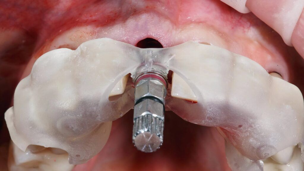 dental implant mounted through the dental template