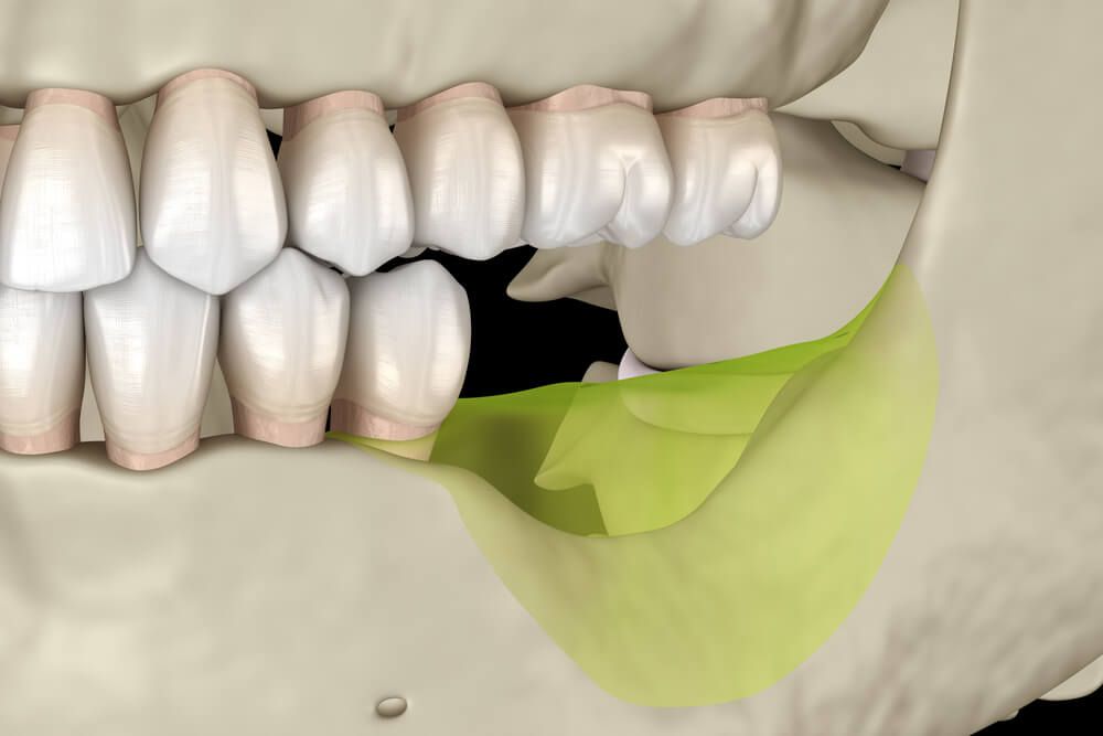Mandibular Jaw, bone recession after losing molars teeth