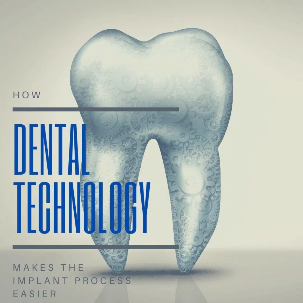 Dental Technology Makes the Implant Process Easier