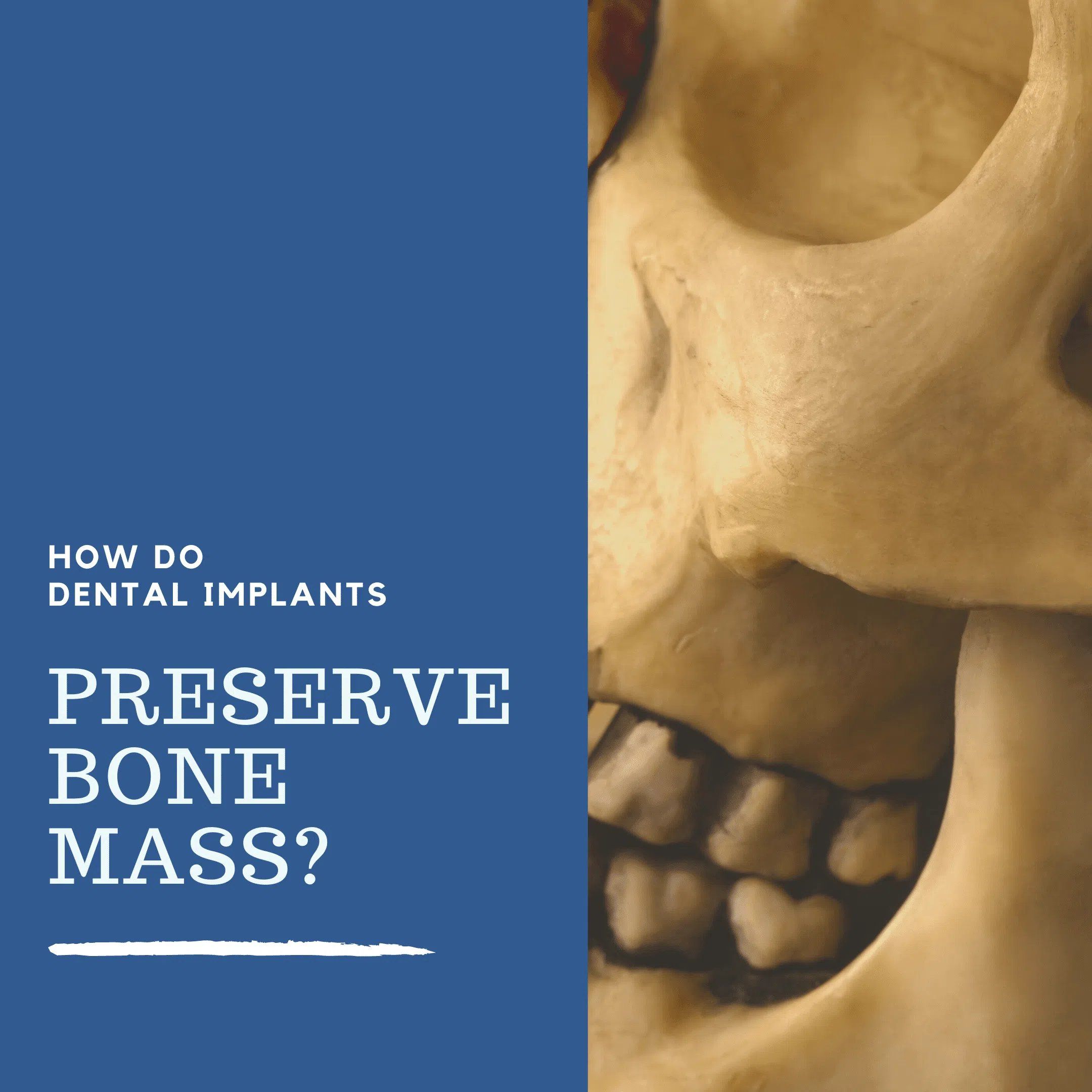 Dental Implants Preserve Bone Mass