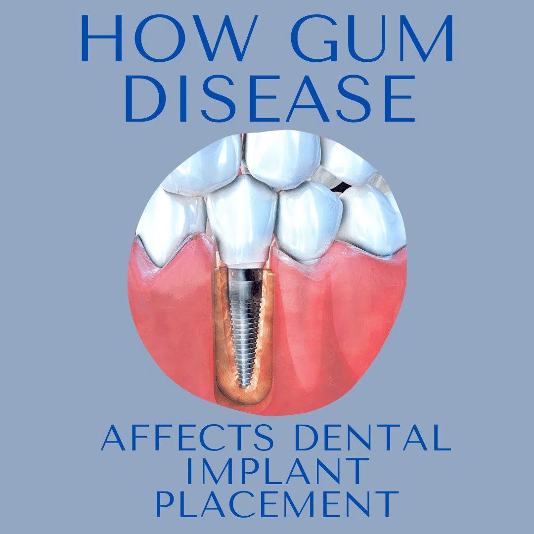 Dental Implant 3d image