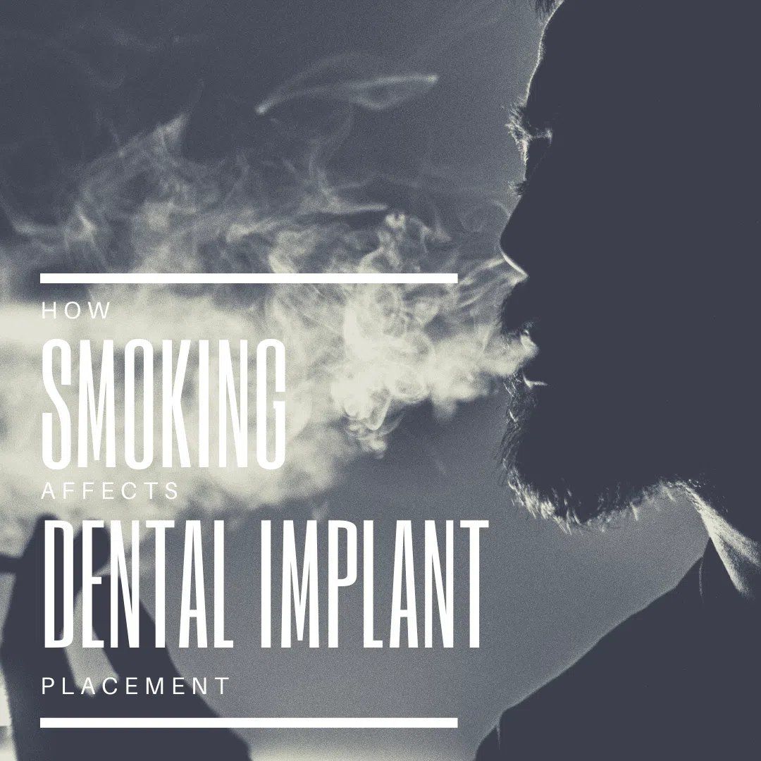 Smoking Affects Dental Implant Placement