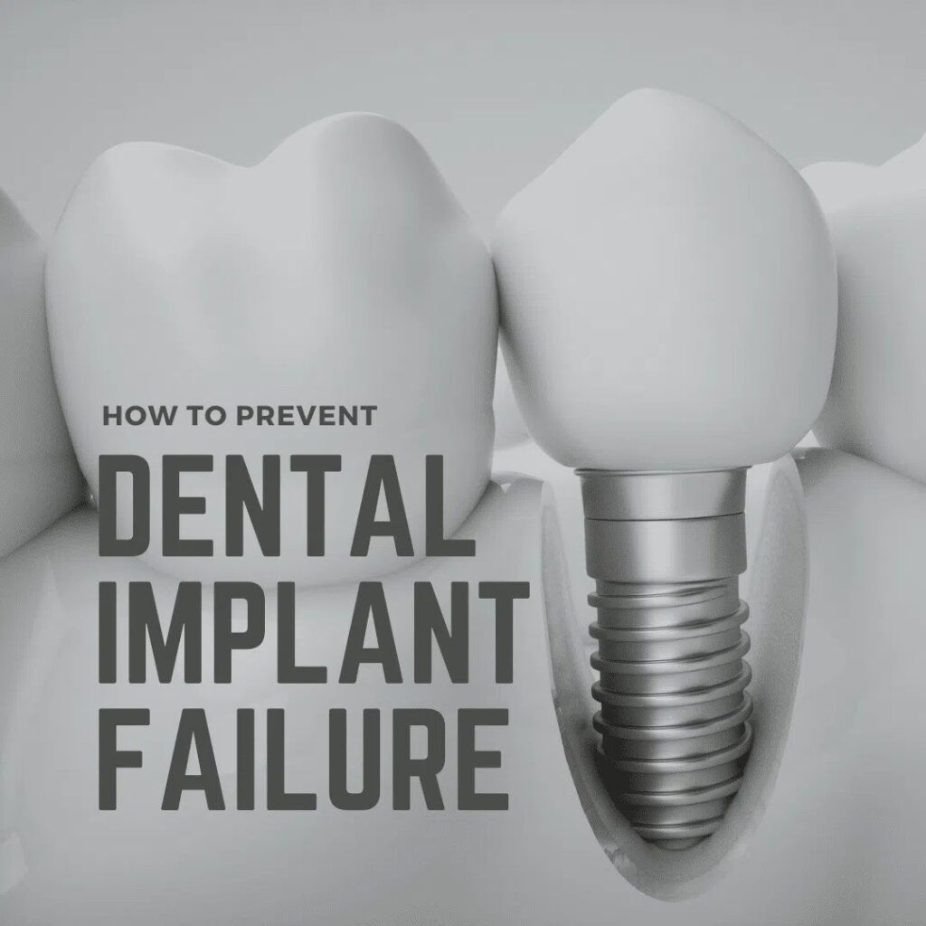 Dental implant 3d image