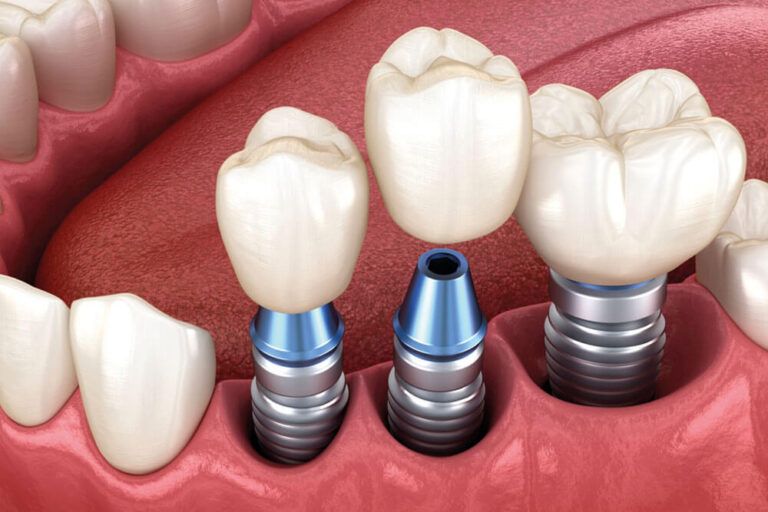 3 tooth crowns placement over 3 implants