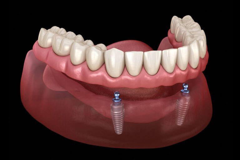 All on 2 system supported by implants with ball attachments