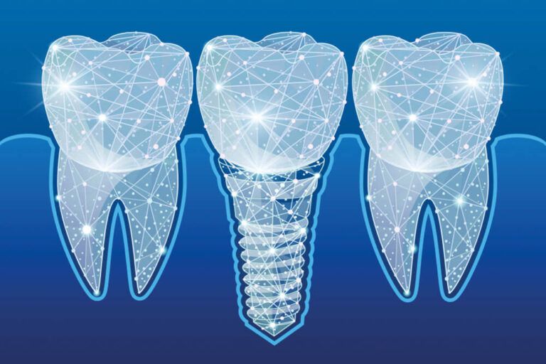 Healthy teeth and dental implant