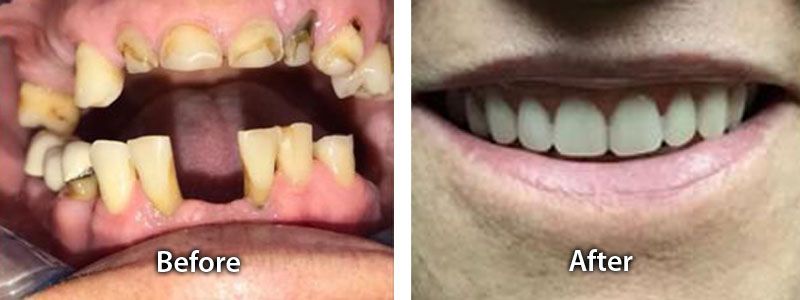 Previous Faulty Dental Work Before after image
