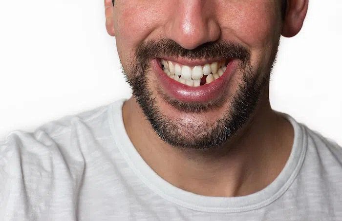 Man with broken tooth smiling