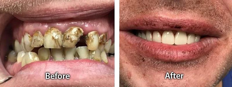 Restoring Original Size and Shape of Teeth Before after image