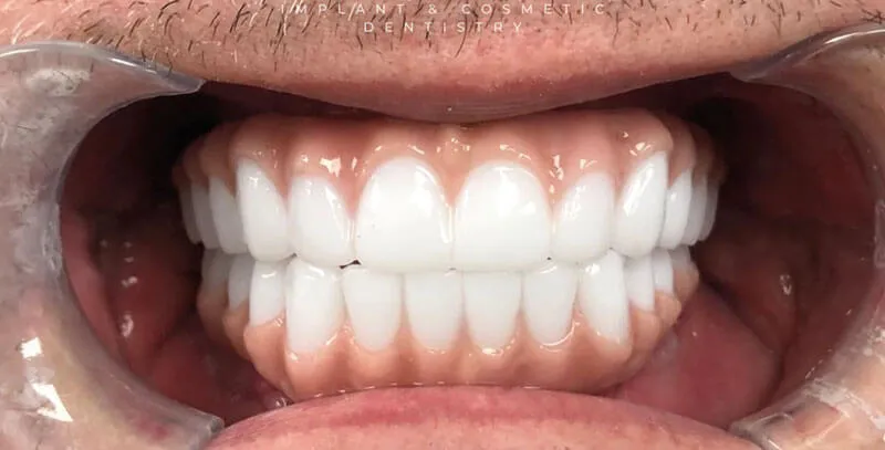 What Are the Main Differences Between Lumineers and Veneers