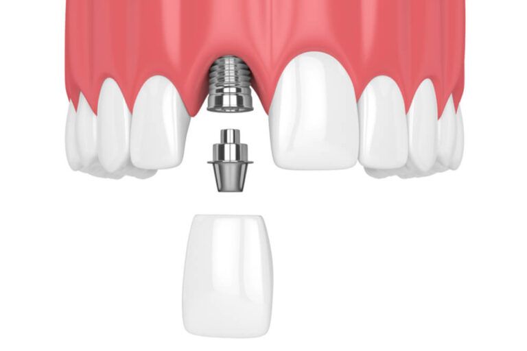3d render of upper jaw with teeth and dental incisor implant