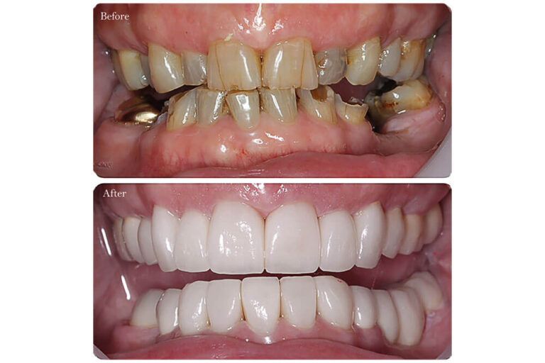 Before and after fixing new teeth for the patient