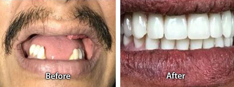 Teeth Replacement with Implants Before after image