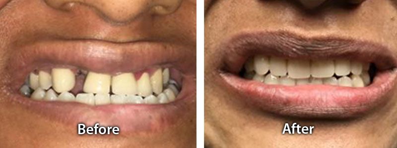 Teeth Shifting Before after image