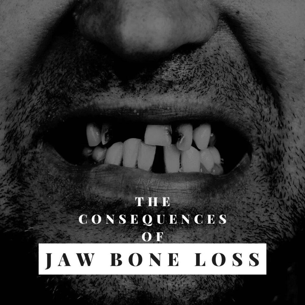 Man with Jaw Bone Loss