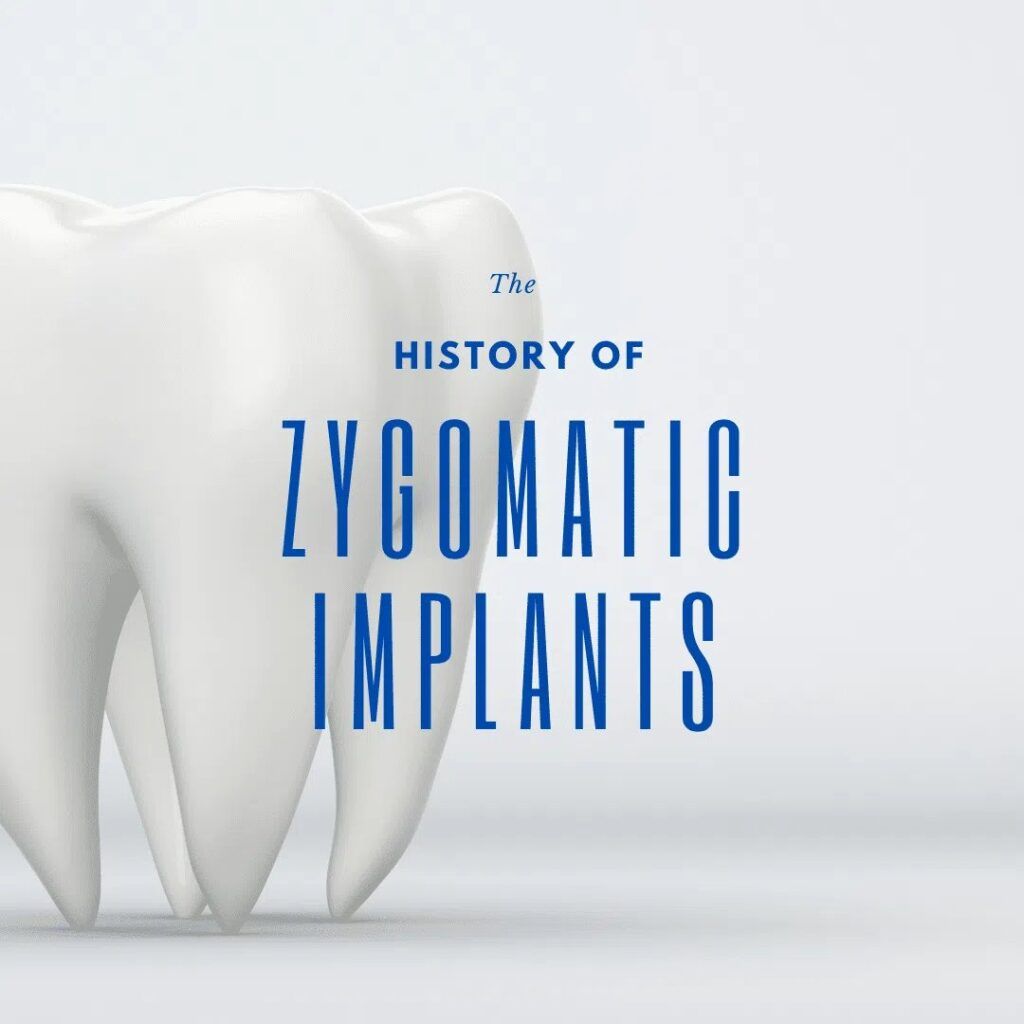 Zygomatic Implants 3D image