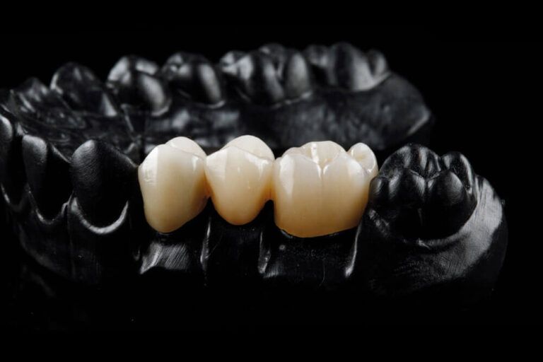 ceramic crowns in the chewing area on the black model